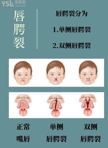 影响唇裂修复价格的因素